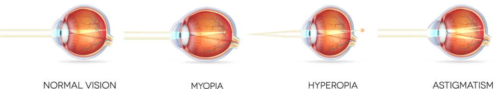 Chart Illustrating Normal Vision, Myopia, Hyperopia and Astigmatism