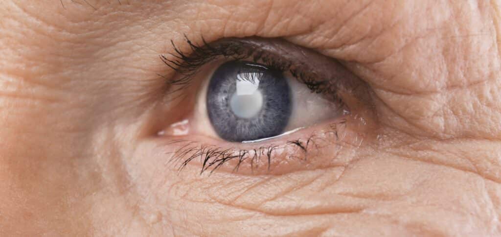 Cataract concept. Senior woman's eye, closeup