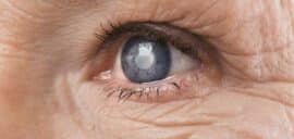 Cataract concept. Senior woman's eye, closeup